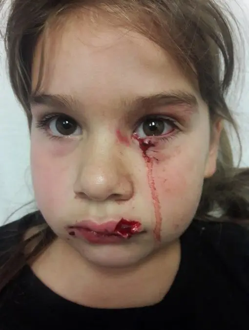 Injured young girl with facial wounds.