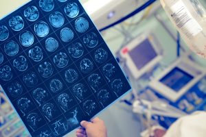 A hand is holding up a printout of an MRI that shows multiple images of the brain.